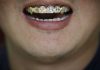 Jeweler on the Grill for Alleged Dental Work Without License