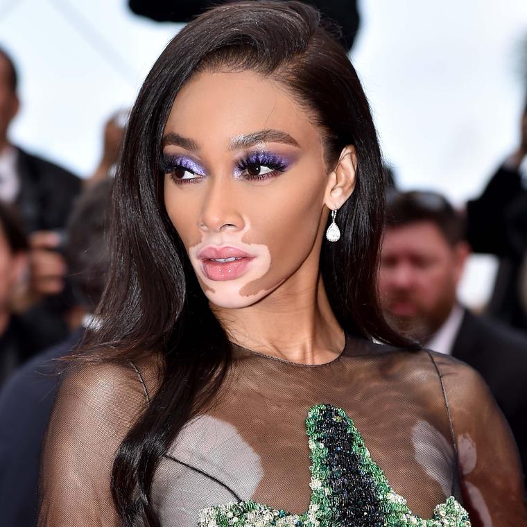 Winnie Harlow